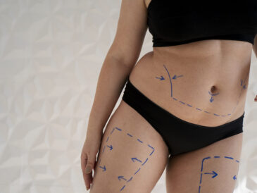 Kvinna målad med penna inför fettsugning