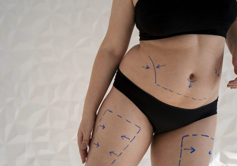 Kvinna målad med penna inför fettsugning